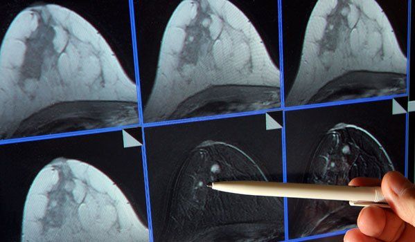 Auf der Bildschirmdarstellung einer Magnetresonanz-(MR)-Mammographie ist ein winziger Tumor in der Brust einer Patientin zu sehen. Quelle: dpa Auf der Bildschirmdarstellung einer Magnetresonanz-(MR)-Mammographie ist ein winziger Tumor in der Brust einer Patientin zu sehen. Quelle: dpa