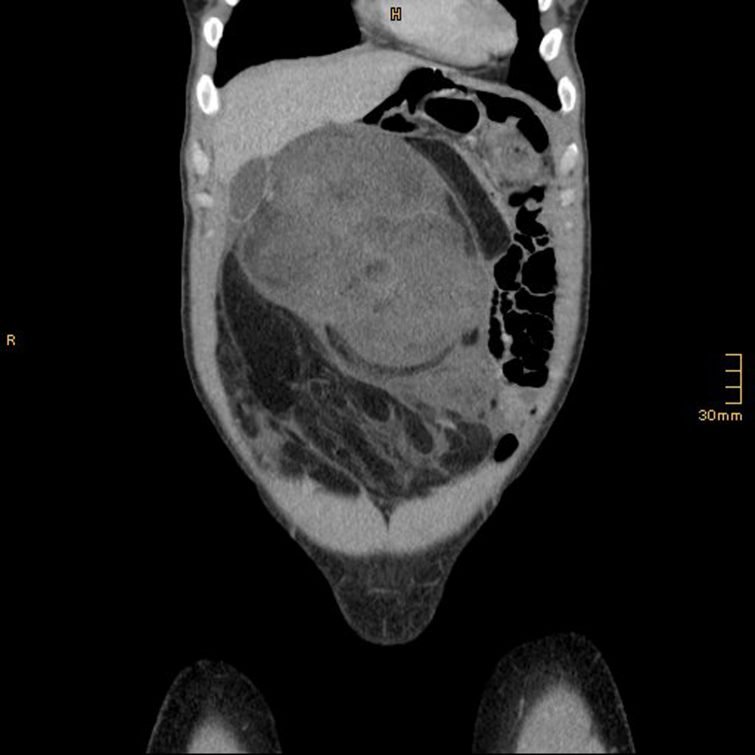 Der Tumor verdrängte nach und nach Darm und Organe. Der Tumor verdrängte nach und nach Darm und Organe.