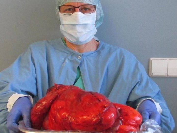 Der Tumor, den die Ärzte in der Oberschwabenklinik in Ravensburg entfernten, wog fast fünf Kilogramm. Der Tumor, den die Ärzte in der Oberschwabenklinik in Ravensburg entfernten, wog fast fünf Kilogramm.