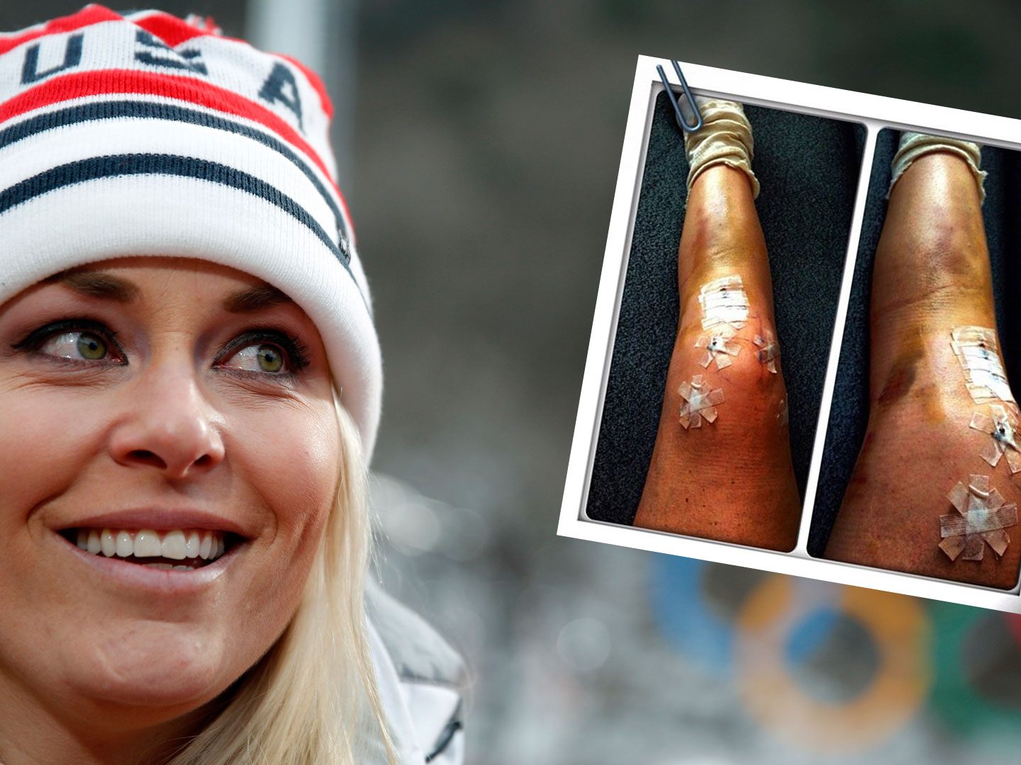 Lindsey Vonn postete jetzt eine Foto ihrer verletzten Beine.