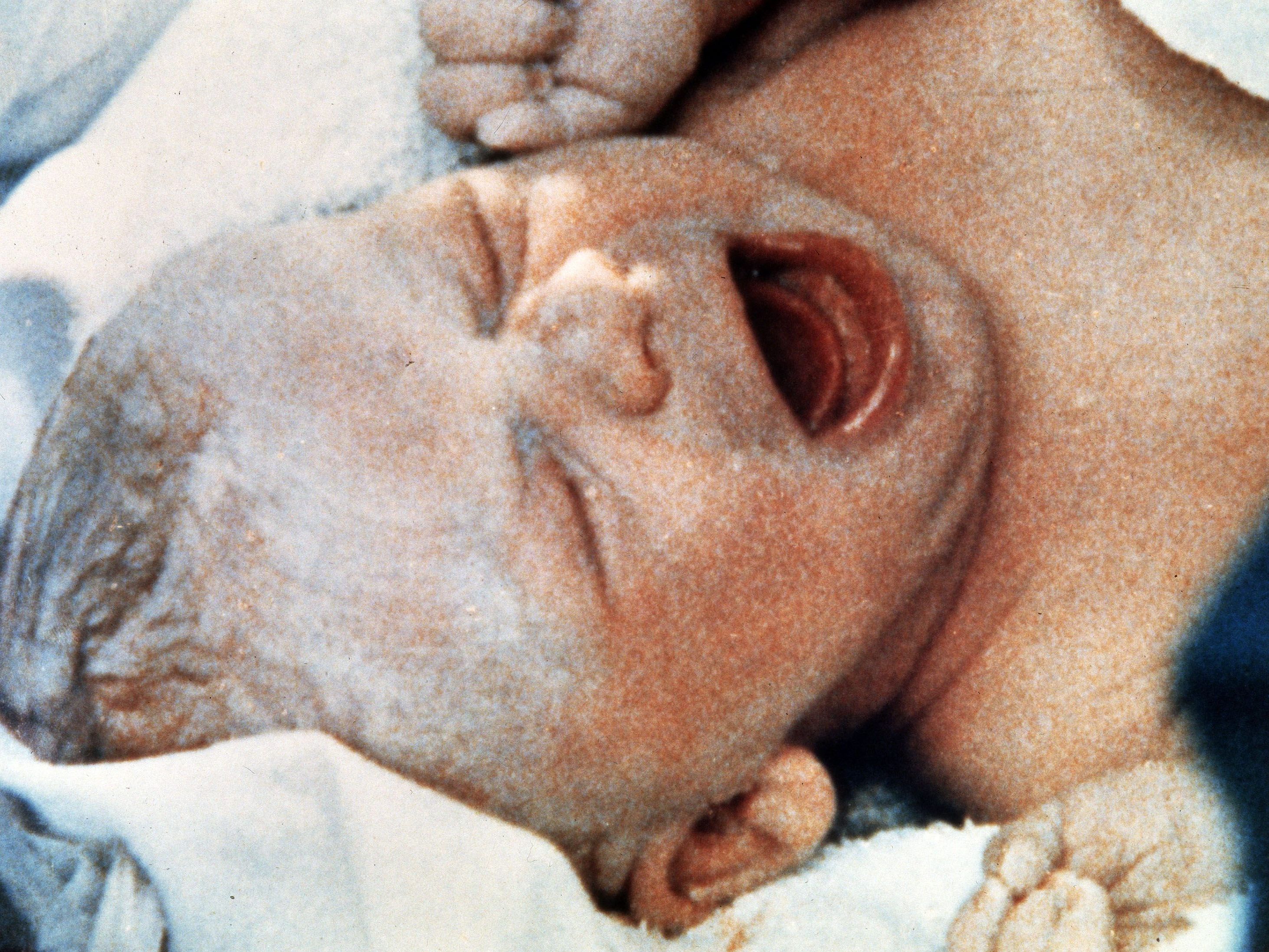 Am 25. Juli 1978 wurde in Grossbritannien ein kleines Maedchen namens Louise Joy Brown geboren.