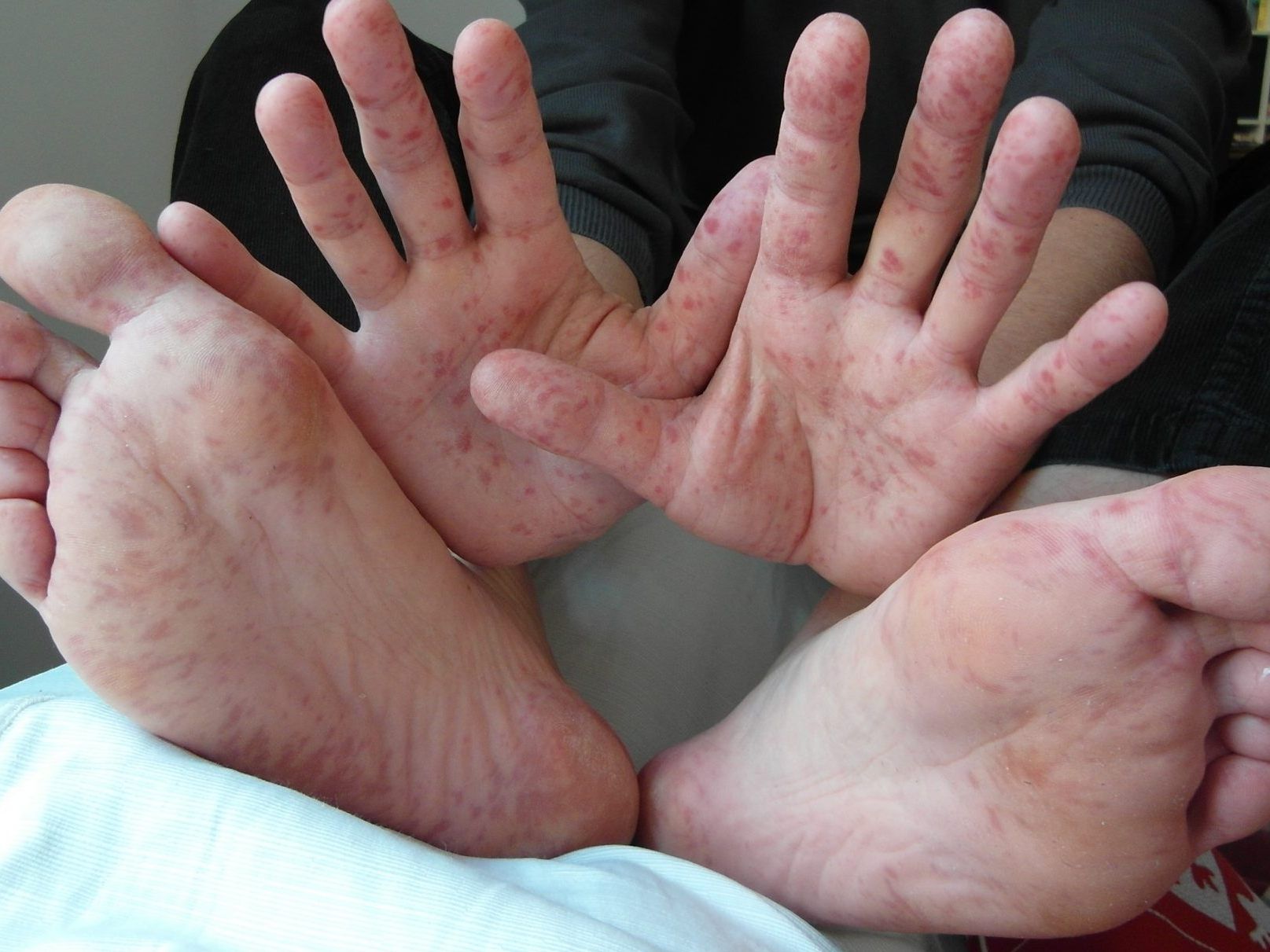 Hand-Fuß-Mund-Krankheit.