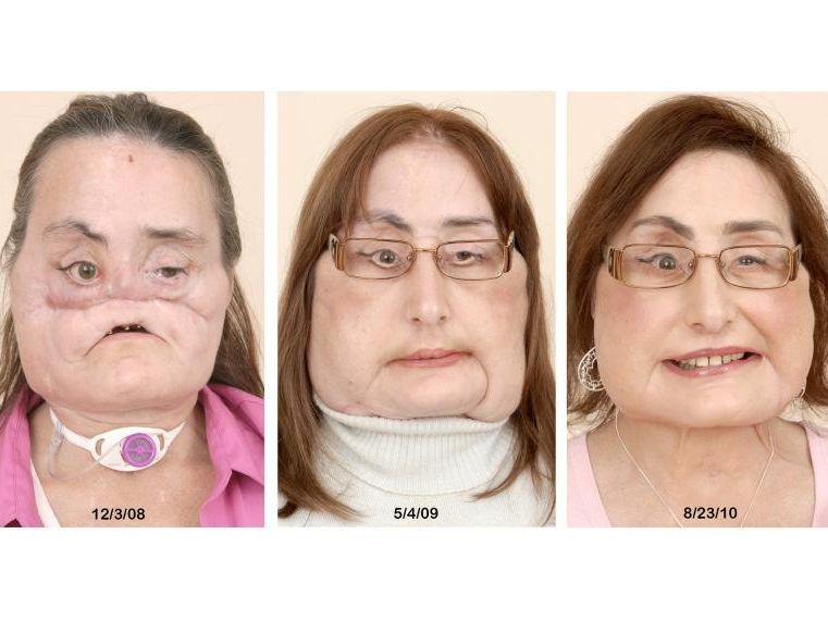Connie Culp erhielt die erste komplette Gesichtstransplantation am 17. Dezember 2008.