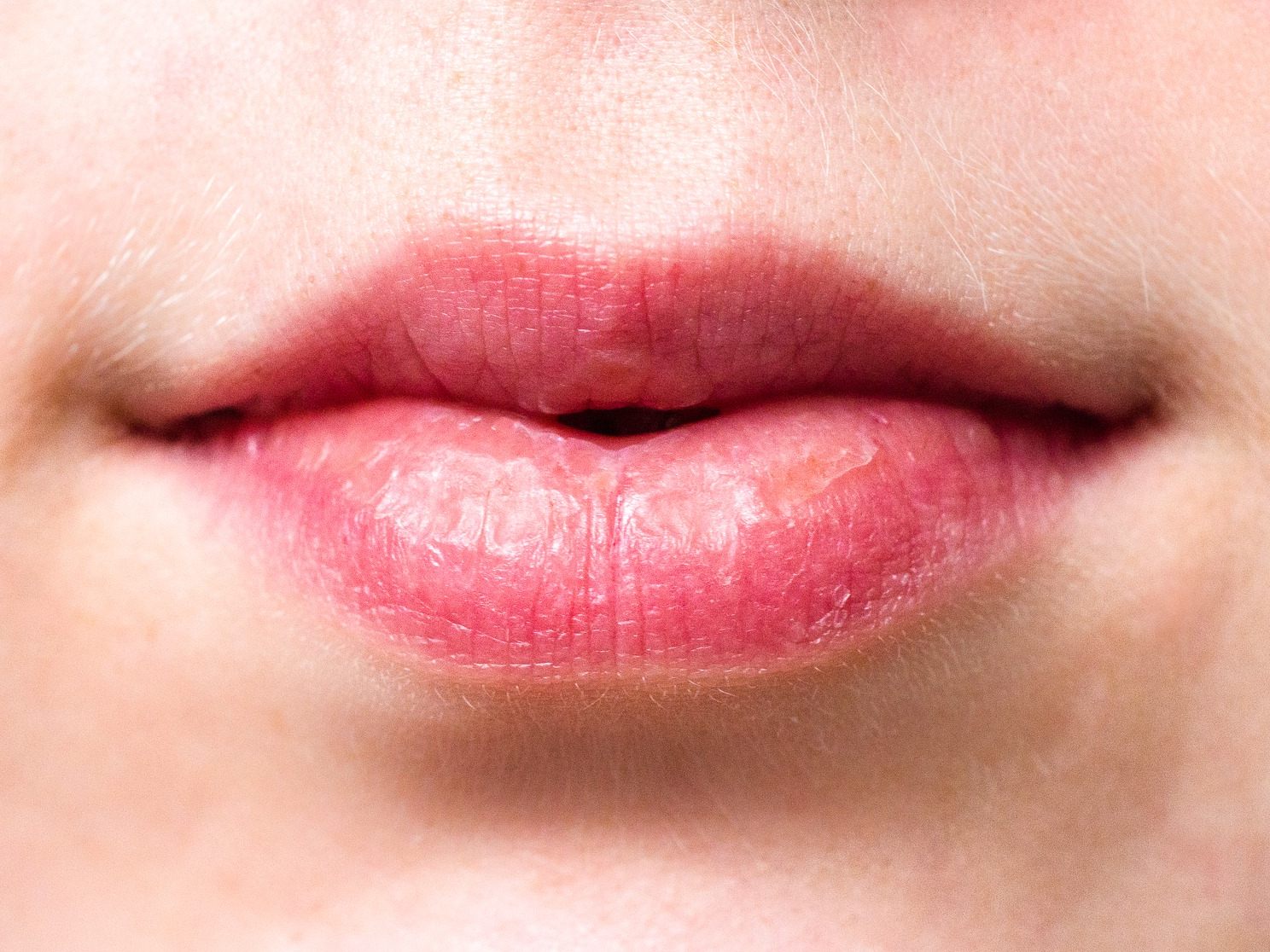 Wenn die Immunkraft sinkt, kommt oft der Lippenherpes. Wenn die Immunkraft sinkt, kommt oft der Lippenherpes.