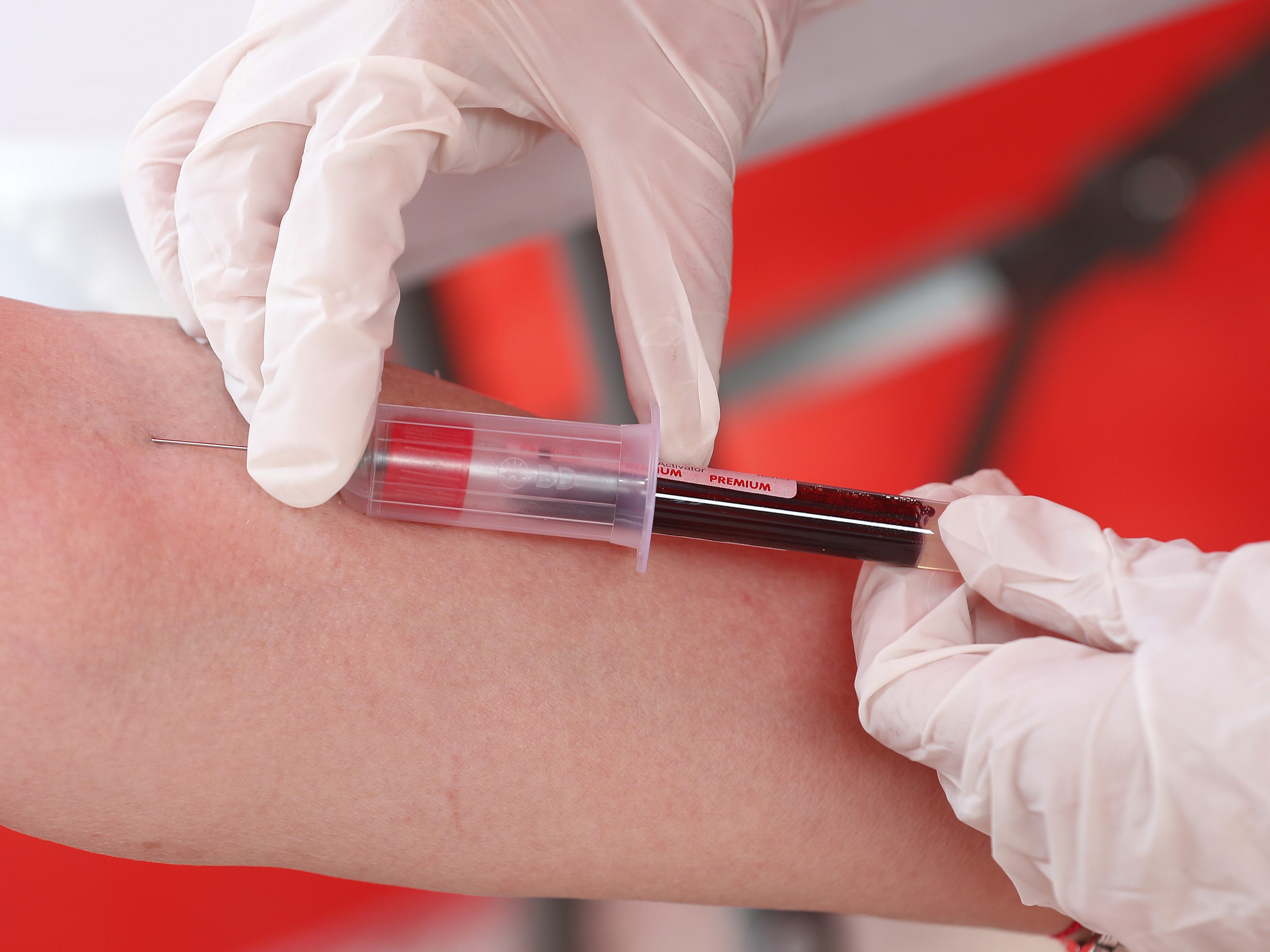 Coronavirus: Hohe Antikörpertiter mit schwerem Verlauf verbunden. Coronavirus: Hohe Antikörpertiter mit schwerem Verlauf verbunden.