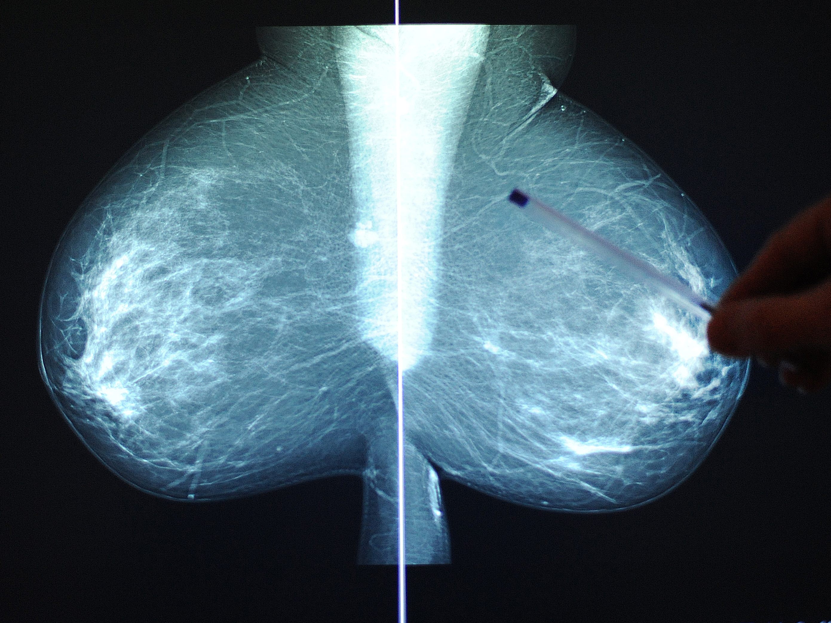 Das Bruströntgenbild einer Patientin im Rahmen einer Vorsorgeuntersuchung zu Brustkrebs. Das Bruströntgenbild einer Patientin im Rahmen einer Vorsorgeuntersuchung zu Brustkrebs.
