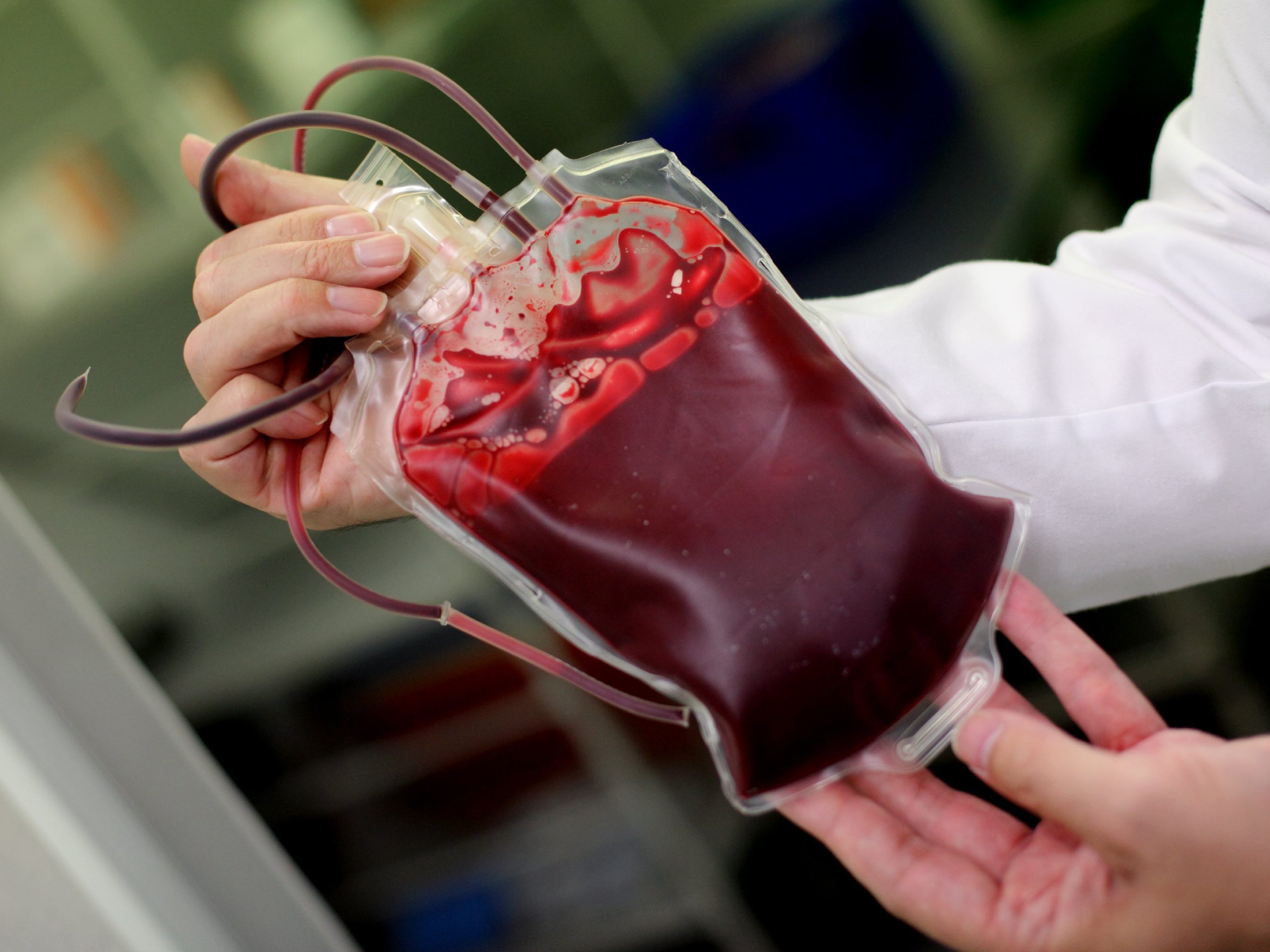 Operation von Bub in Italien: Eltern verlangen Blut von Ungeimpften Operation von Bub in Italien: Eltern verlangen Blut von Ungeimpften