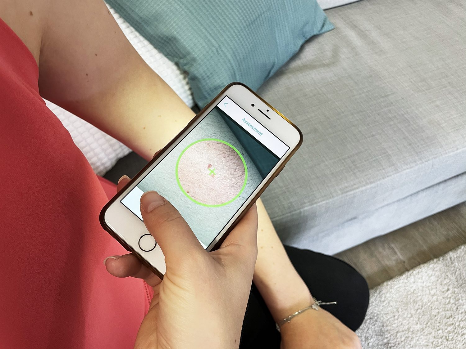 Die App "SkinScreener" erkennt mit einer Sicherheit von 98 Prozent "klinisch relevante Hauttumore".