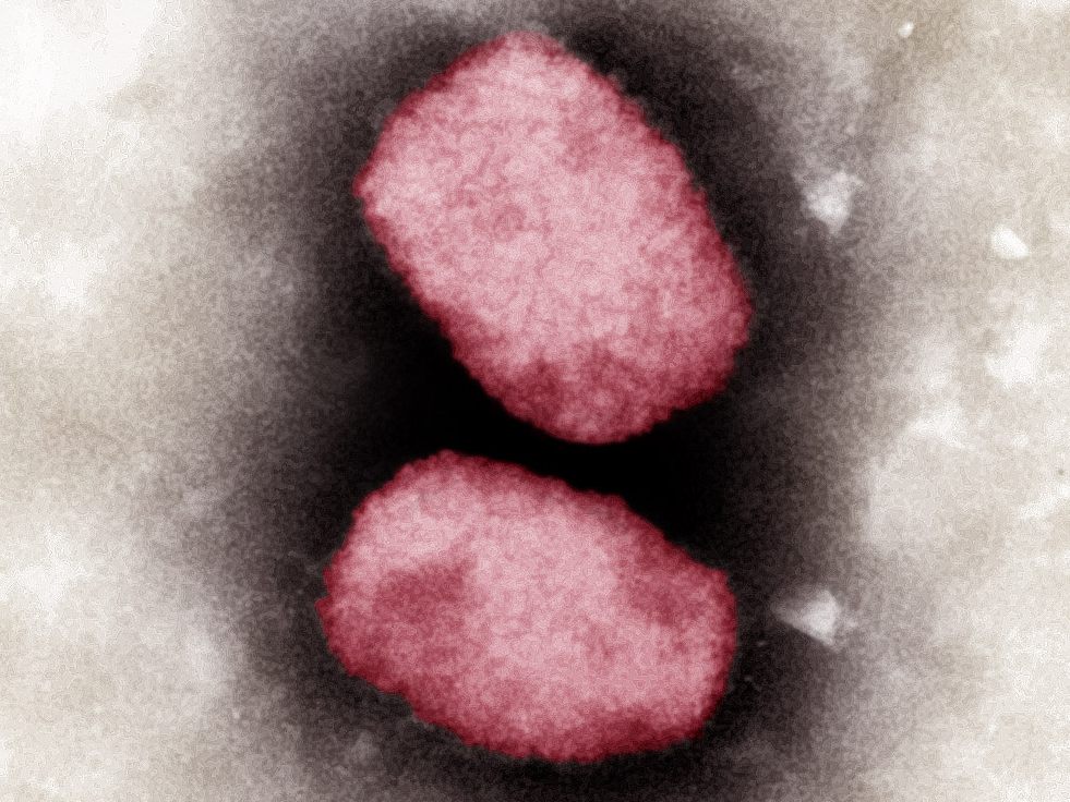 Es gibt weiterhin nur einen Fall von Affenpocken in Österreich