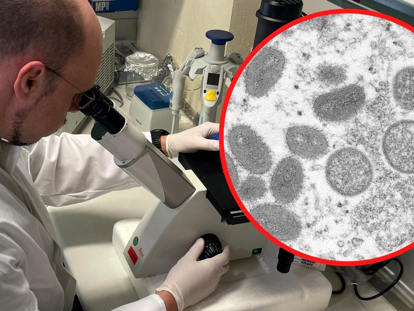 35-Jähriger wies typische Symptome der Affenpocken auf - Genaue Diagnose spätestens Montagfrüh erwartet. 35-Jähriger wies typische Symptome der Affenpocken auf - Genaue Diagnose spätestens Montagfrüh erwartet.