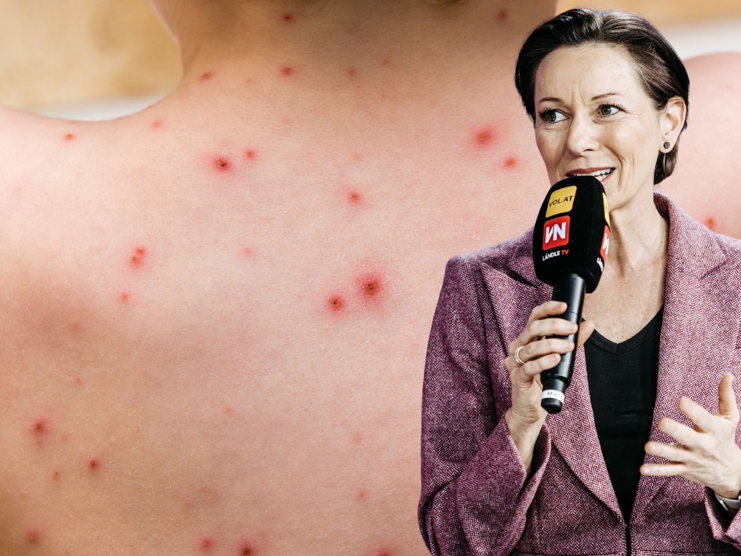 Laut Landesrätin Martina Rüscher wurde der erste Affenpocken-Fall in Vorarlberg bestätigt. Laut Landesrätin Martina Rüscher wurde der erste Affenpocken-Fall in Vorarlberg bestätigt.