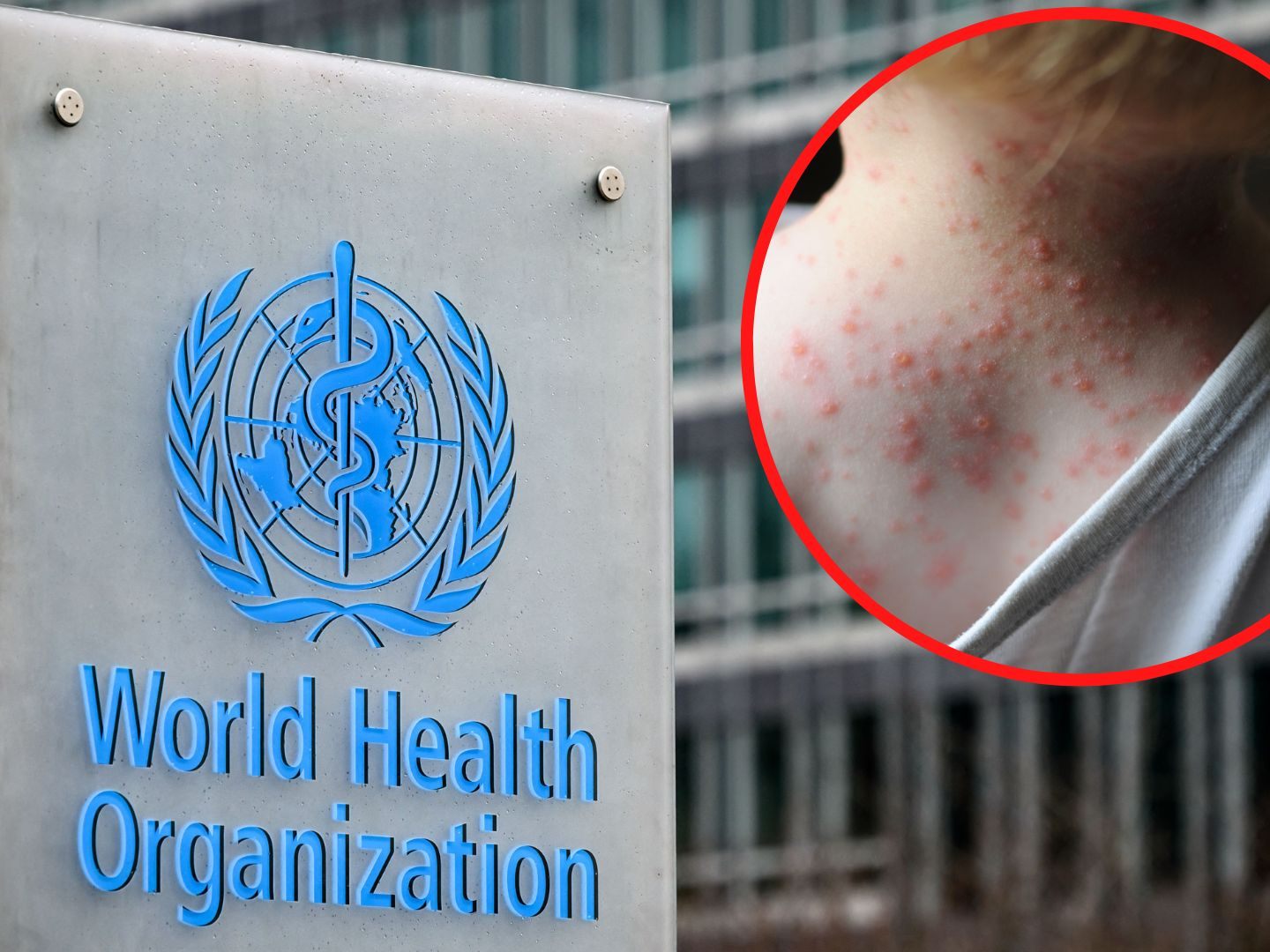 Die WHO entscheidet am Samstag über den Gesundheitsnotstand aufgrund von Affenpocken, Die WHO entscheidet am Samstag über den Gesundheitsnotstand aufgrund von Affenpocken,