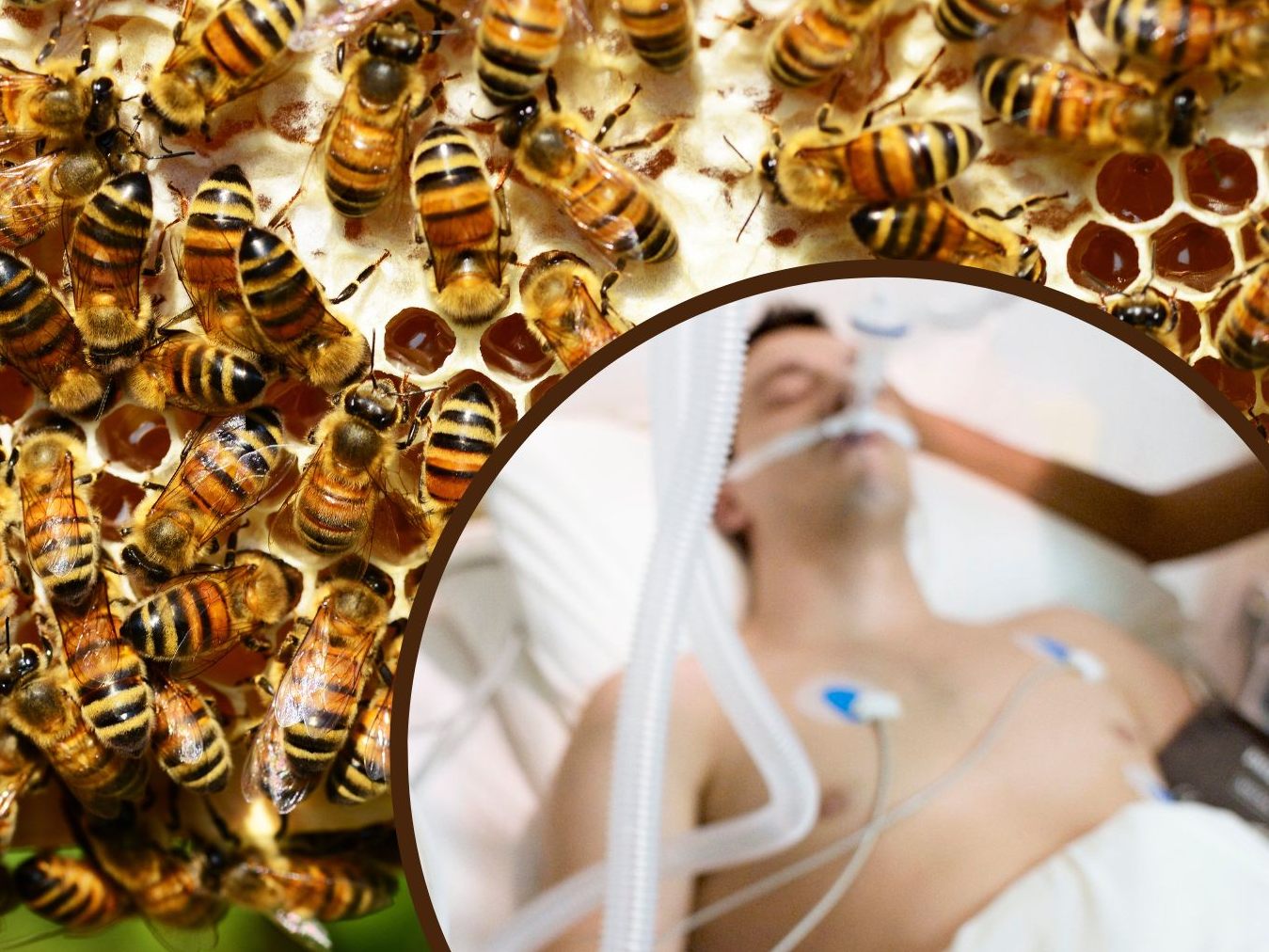 Ein 20-Jähriger musste ins künstliche Koma versetzt werden, nachdem er 20.000 Mal von Killerbienen gestochen worden war.