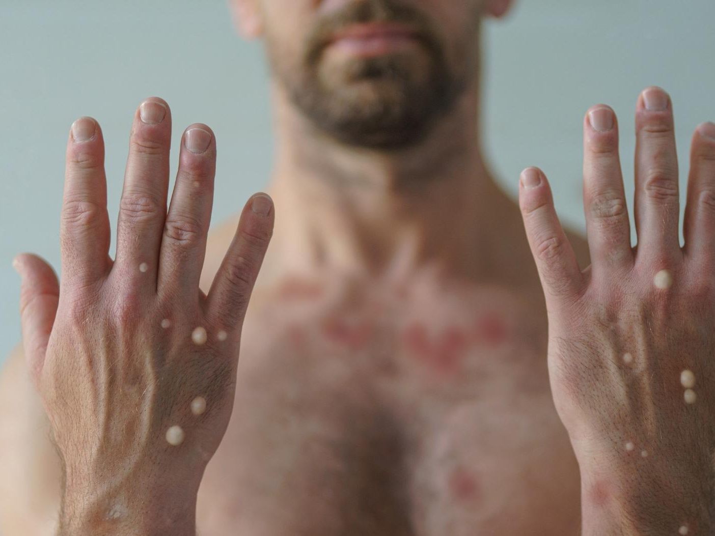 Bei der Variante "Clade I" handelt es sich laut "New Scientist"-Magazin um eine viel aggressivere Mutation. Bei der Variante "Clade I" handelt es sich laut "New Scientist"-Magazin um eine viel aggressivere Mutation.