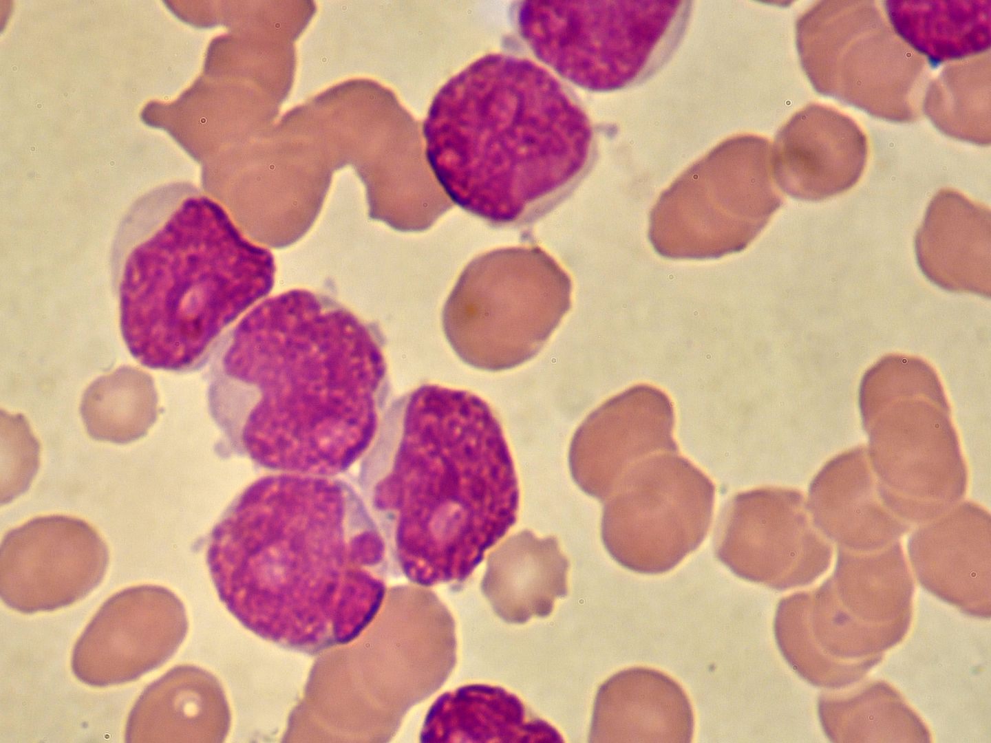 Die neue CLL-Behandlungsmethode funktioniert besser und ist verträglicher. Die neue CLL-Behandlungsmethode funktioniert besser und ist verträglicher.