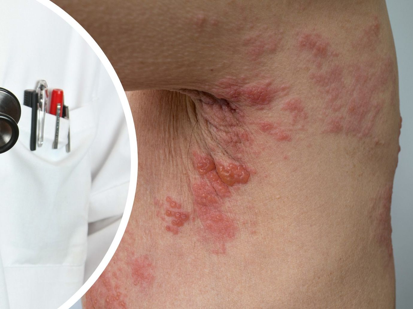 Gegen Herpes-Zoster gibt es eine Impfung. Gegen Herpes-Zoster gibt es eine Impfung.