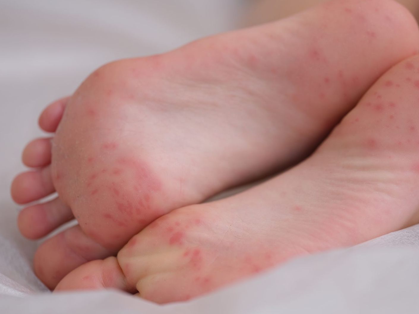Stecknadelgroße rote Punkte auf der Haut können bei Kindern auf eine Blutvergiftung oder Hirnhautentzündung hinweisen. Stecknadelgroße rote Punkte auf der Haut können bei Kindern auf eine Blutvergiftung oder Hirnhautentzündung hinweisen.