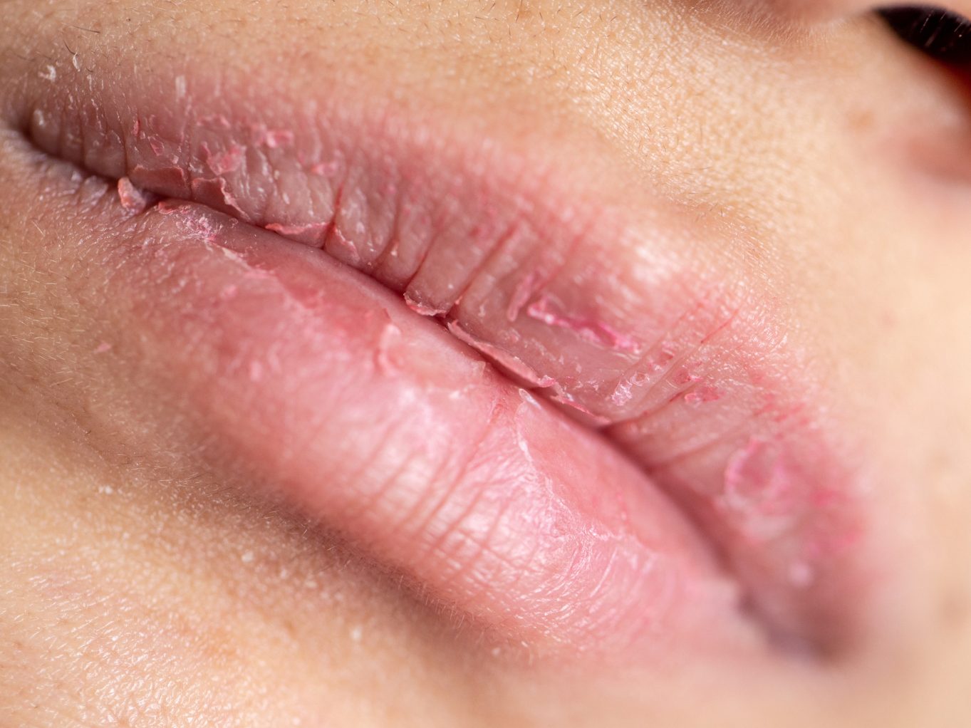 Ganz gleich, ob es die eisige Außenluft oder die trockene Heizungsluft drinnen ist – beide entziehen der Haut um die Lippen Feuchtigkeit und zählen zu den Hauptursachen für spröde Lippen im Winter.