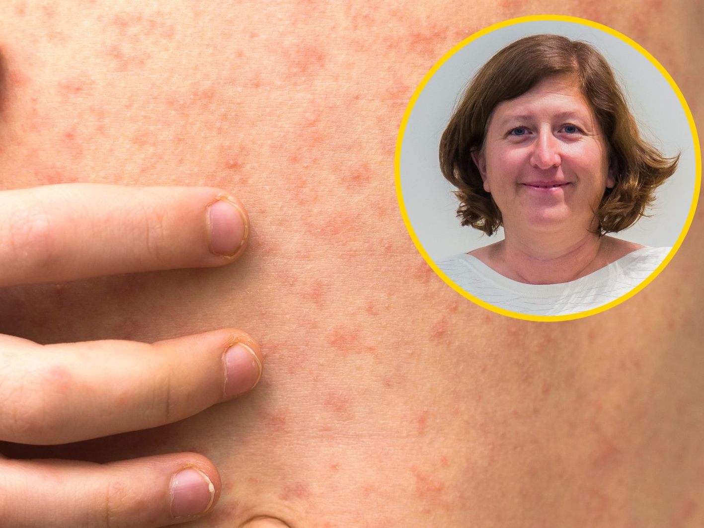 Dr. Daniela Jonas warnt zur Vorsicht und macht sich für die Masern-Impfung stark.