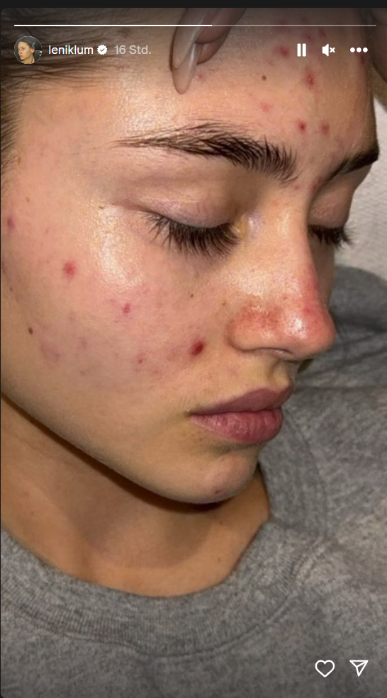 Leni Klum teilt auf Instagram ihre Probleme mit Akne