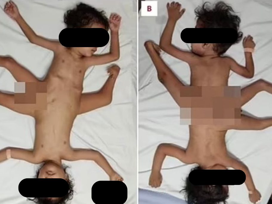 Die beiden Jungen wurden operiert.
