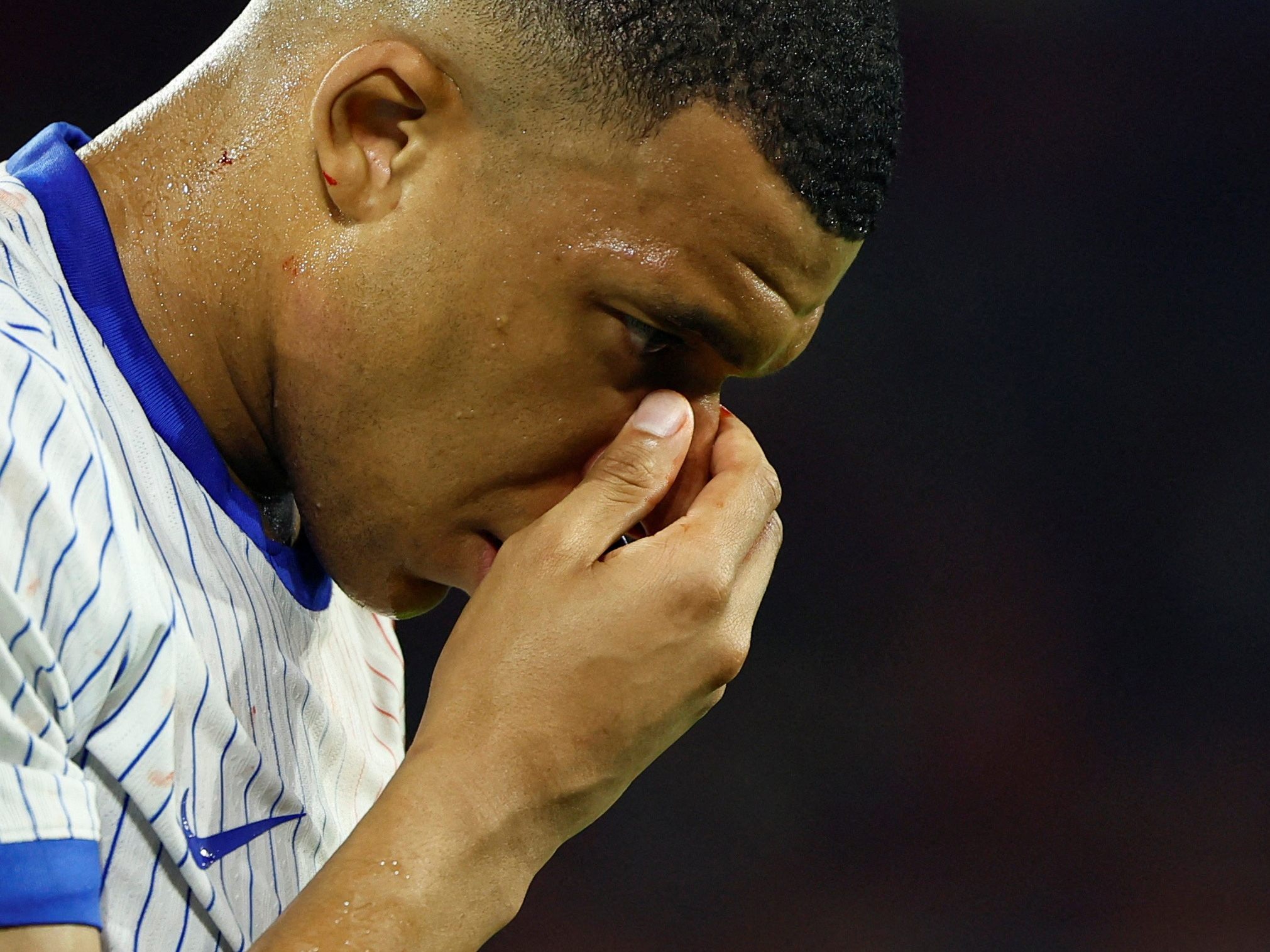 Der Nasenbeinbruch von Mbappe wurde bestätigt.