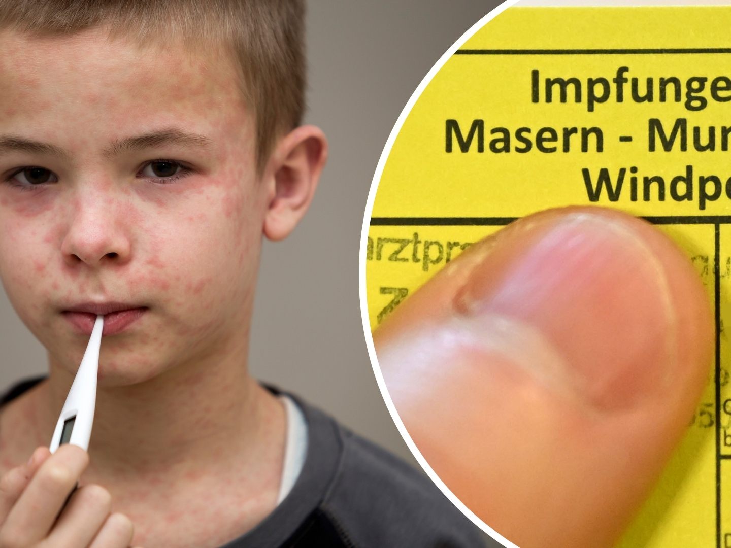 Impfung schützt vor Erkrankung, besonders bei Masern.