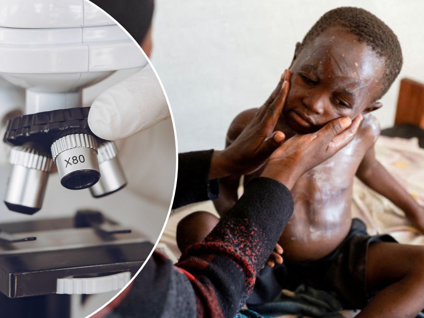 Das Gesundheitswesen des Landes kämpft bereits seit Monaten mit einem Ausbruch der Krankheit Mpox. Das Gesundheitswesen des Landes kämpft bereits seit Monaten mit einem Ausbruch der Krankheit Mpox.