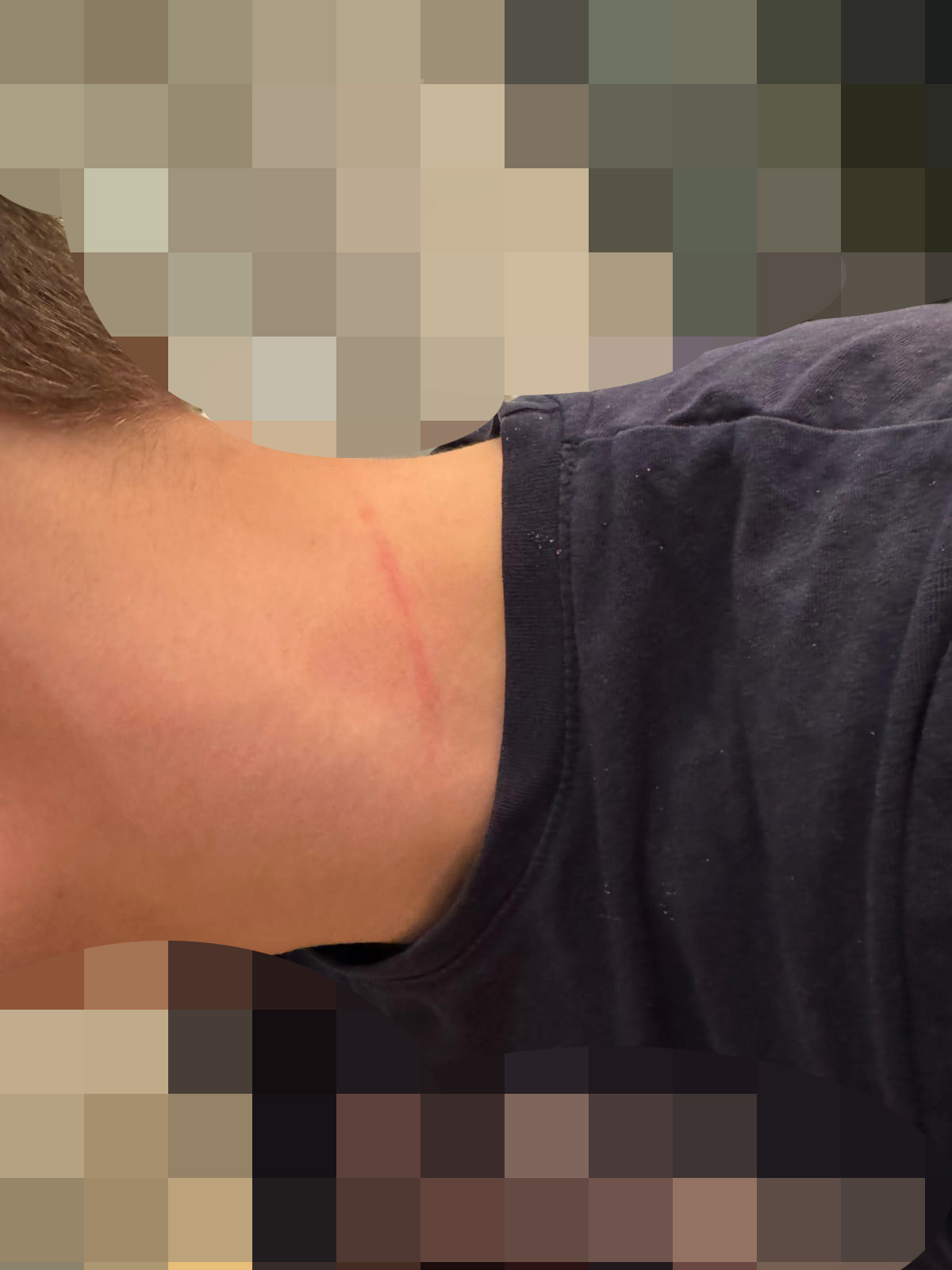 Das Foto zeigt einen langen Kratzer, der sich an seinem Hals entlangzieht. Das Foto zeigt einen langen Kratzer, der sich an seinem Hals entlangzieht.