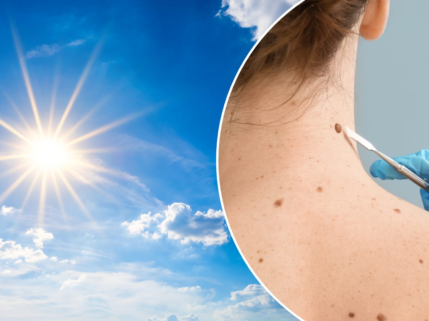 Die Klimakrise hat massive Auswirkungen auf die Gesundheit - u. a. auch auf die Haut.