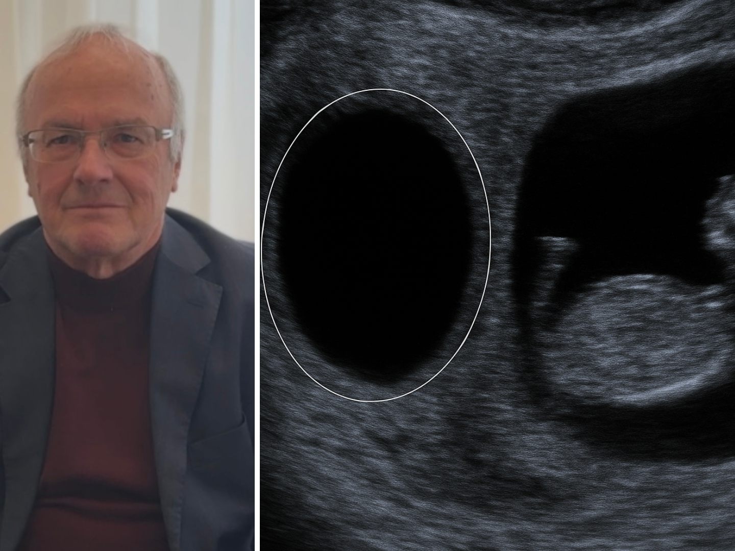Das "Vanishing Twin Syndrome" ist in der psychologie ein sehr umstrittenes Thema. Das "Vanishing Twin Syndrome" ist in der psychologie ein sehr umstrittenes Thema.