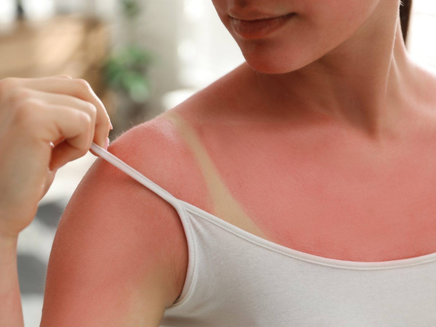 Tipps gegen Sonnenbrand.