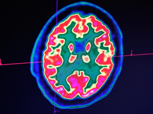 Laut Schweizer Medizinern Meilenstein für Therapie Laut Schweizer Medizinern Meilenstein für Therapie