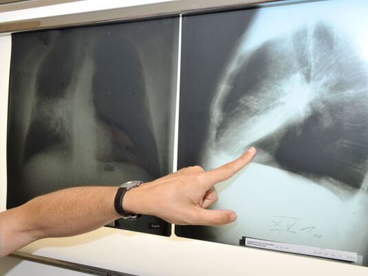 Digitale Information verbessert Lungenkrebs-Früherkennung