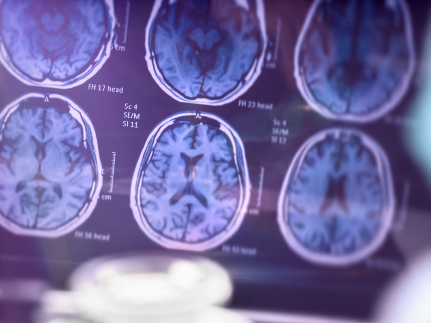 Krebs und Schlaganfall weiterhin gefürchteter als Alzheimer (Symbolbild)