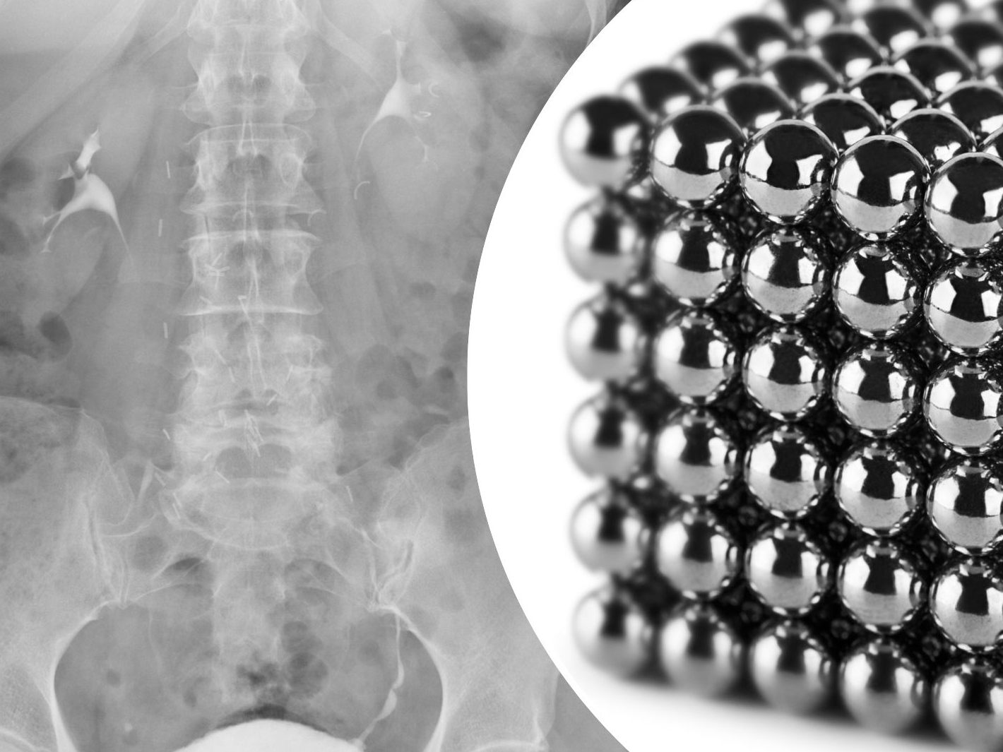 Teenager verschluckte bis zu 100 Hochleistungsmagneten (SYMBOLBILD)