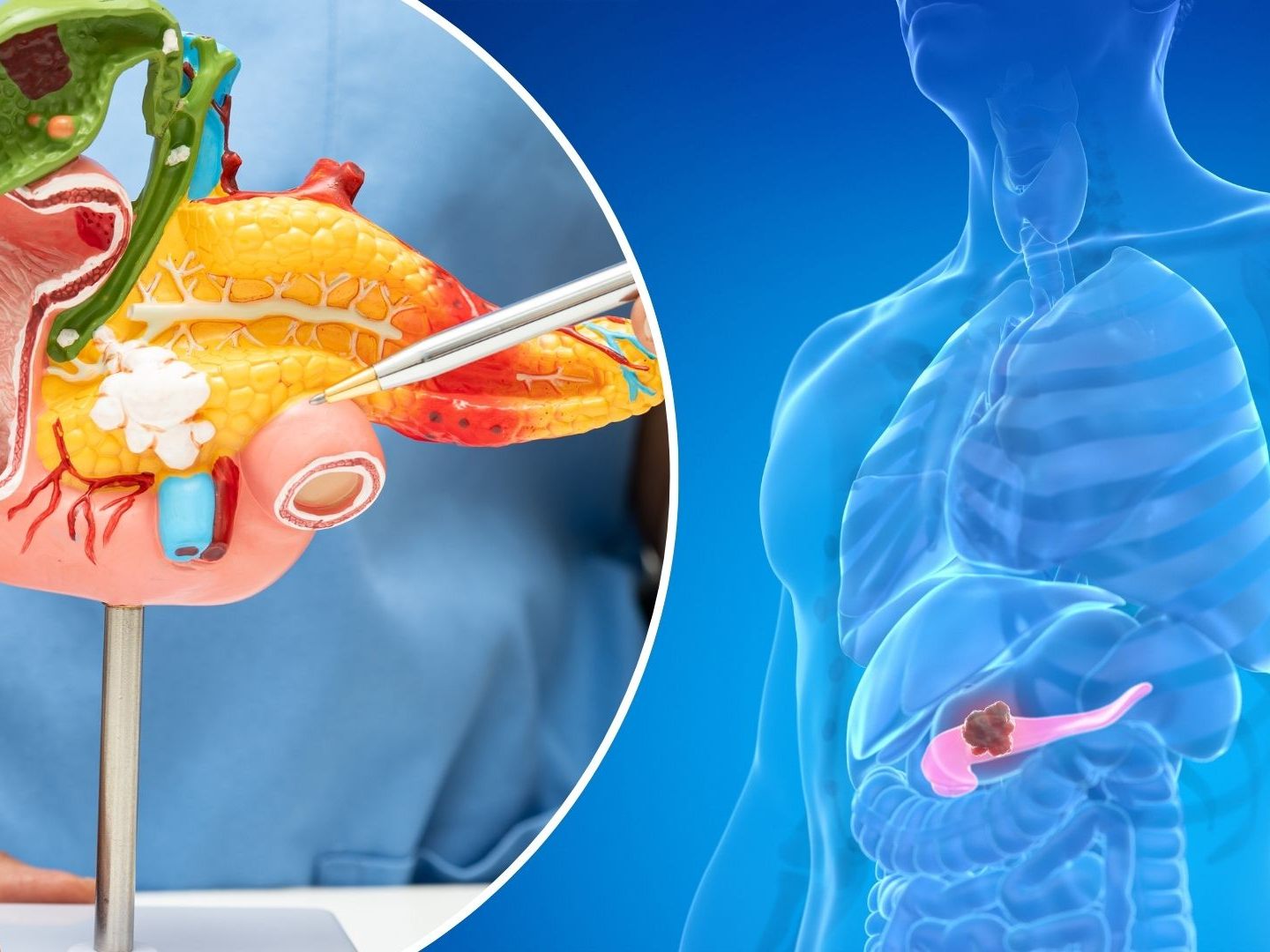 Diese Symptome deuten auf Bauchspeicheldrüsenkrebs hin.