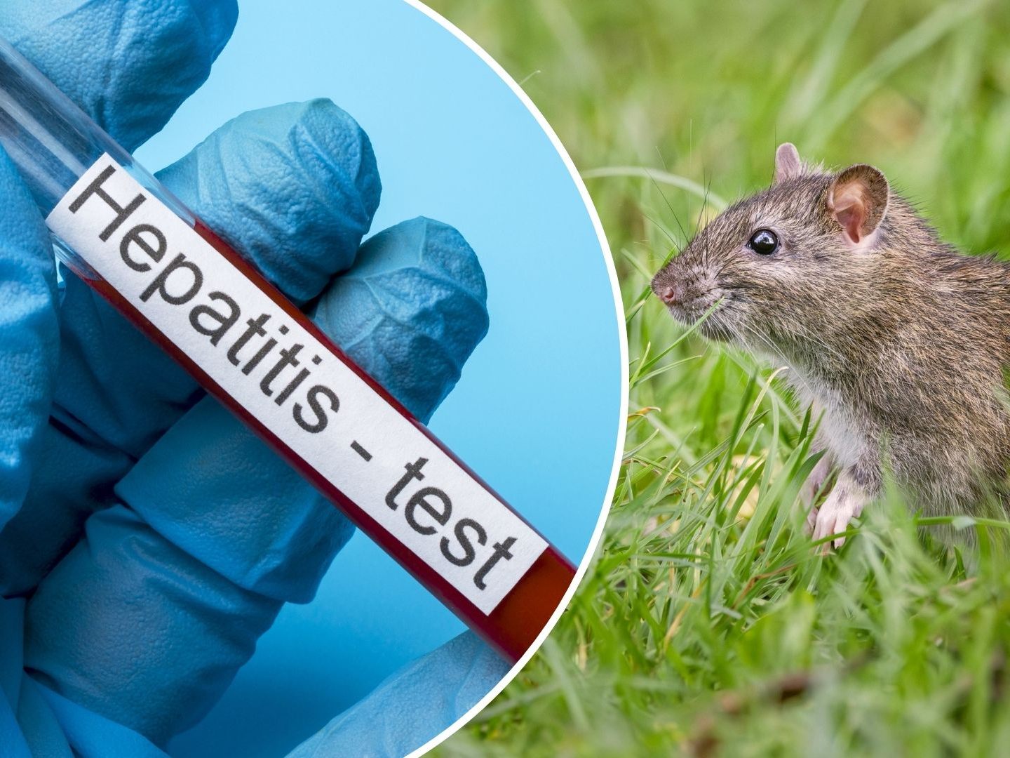 Seltene Hepatitis-E-Variante bei Mann entdeckt