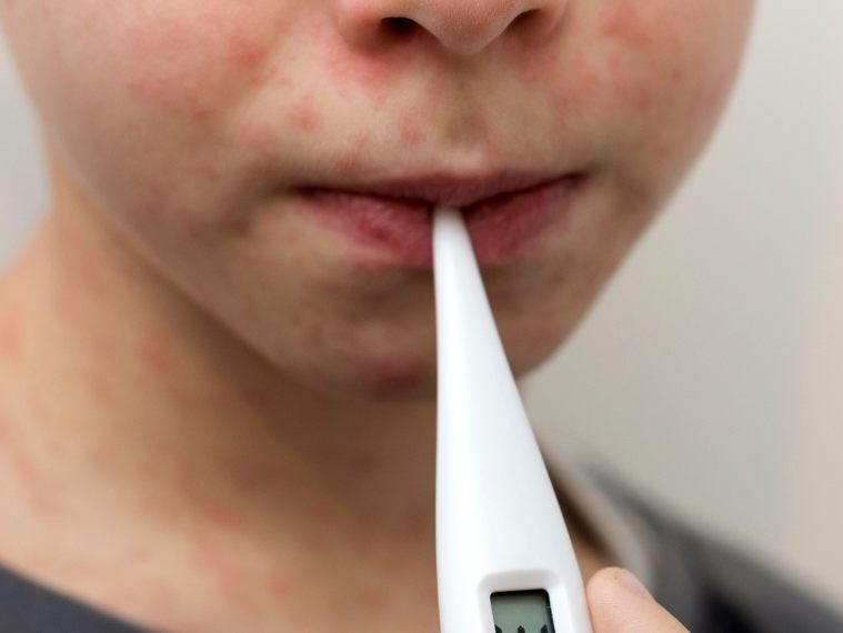 Masernfall in Erding – Gäste sollen Impfschutz prüfen. (Symbolbild)