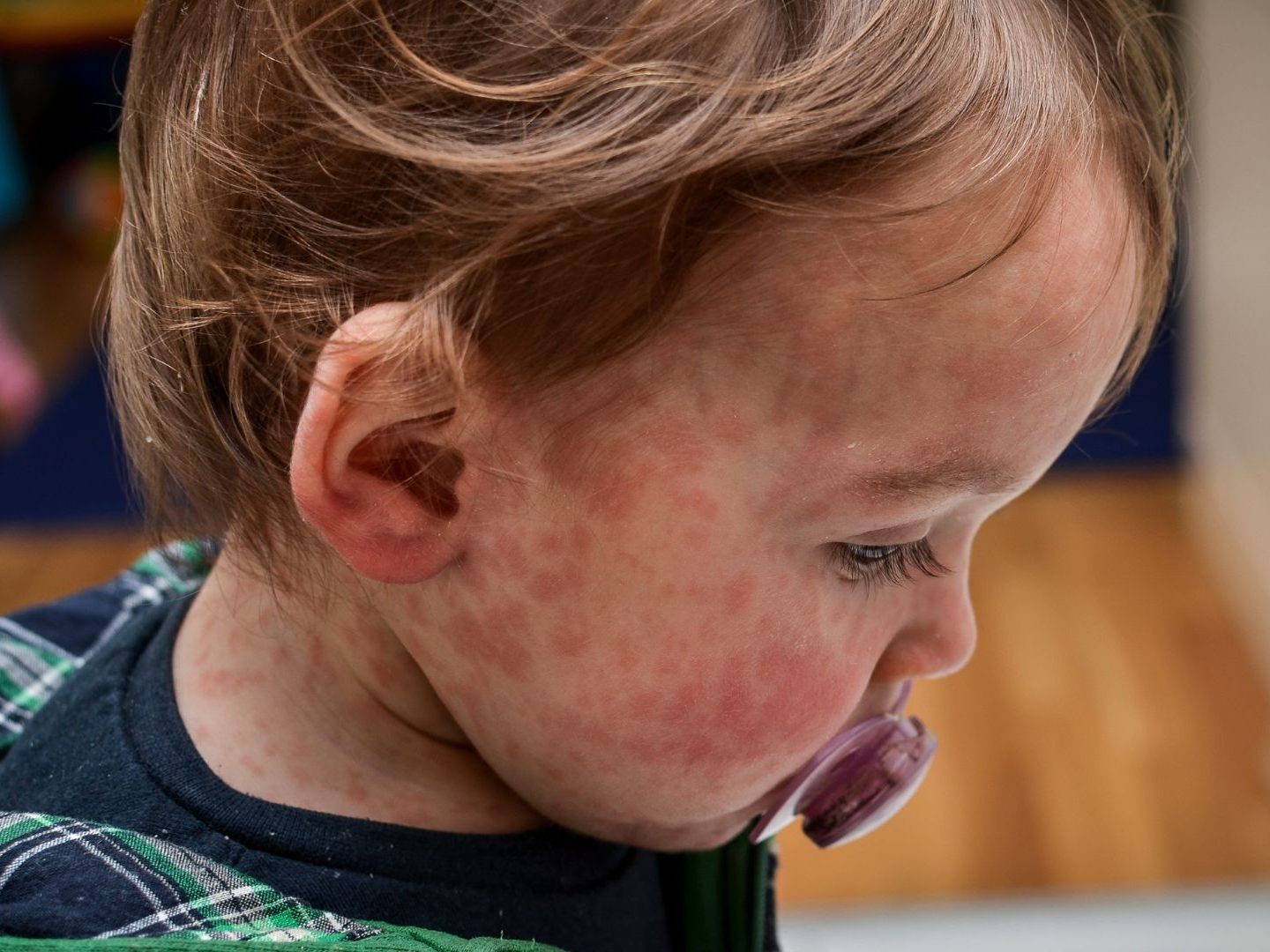 Viele Krankheiten, wie beispielsweise die Masern, erleben wegen der fehlenden Durchimpfungsrate gerade ein Revival.
